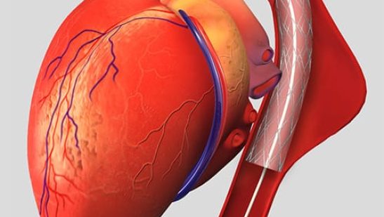 Aortic Aneurysm Treatment in Jaipur
